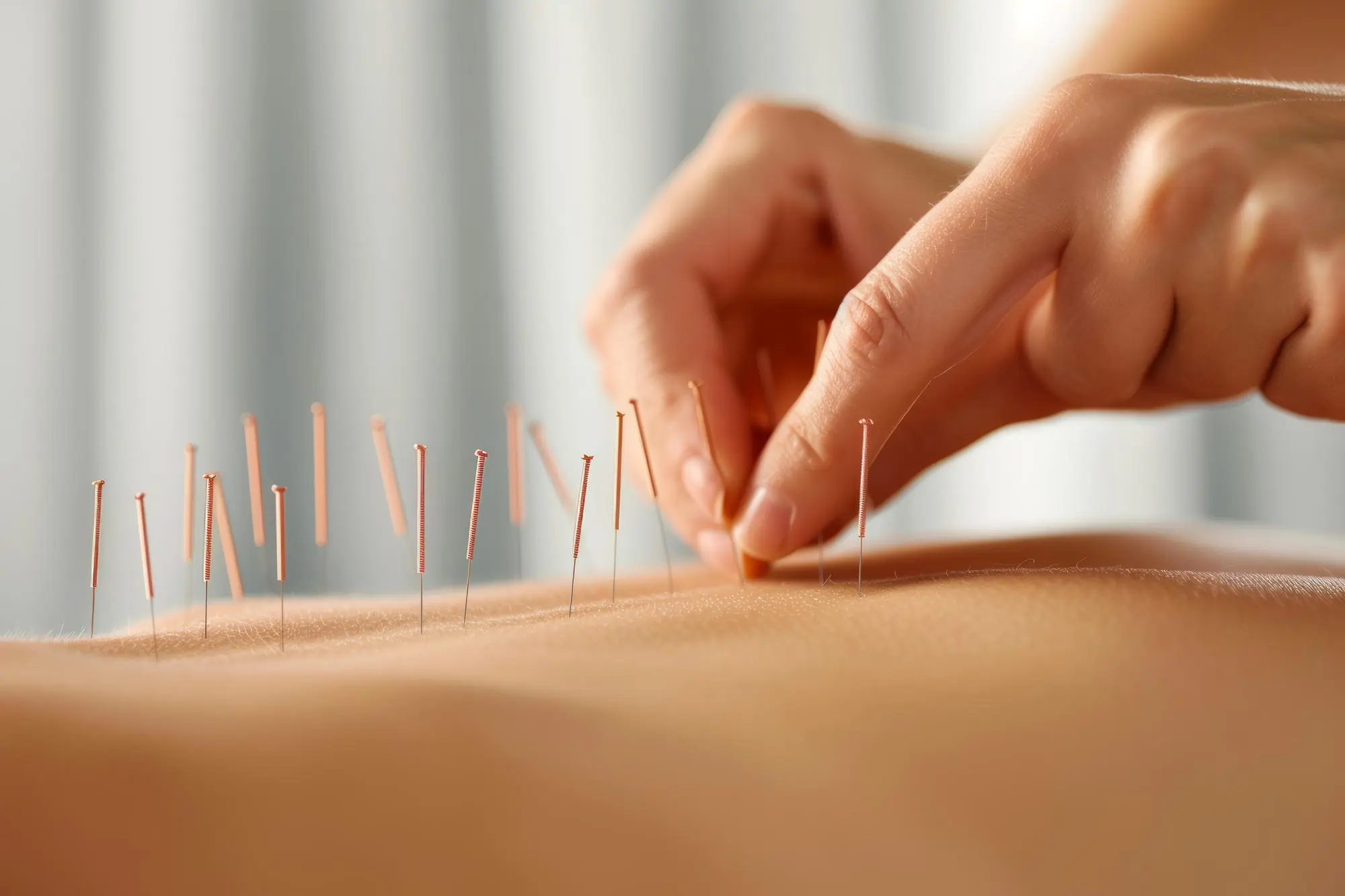 18095 Acupuncture
