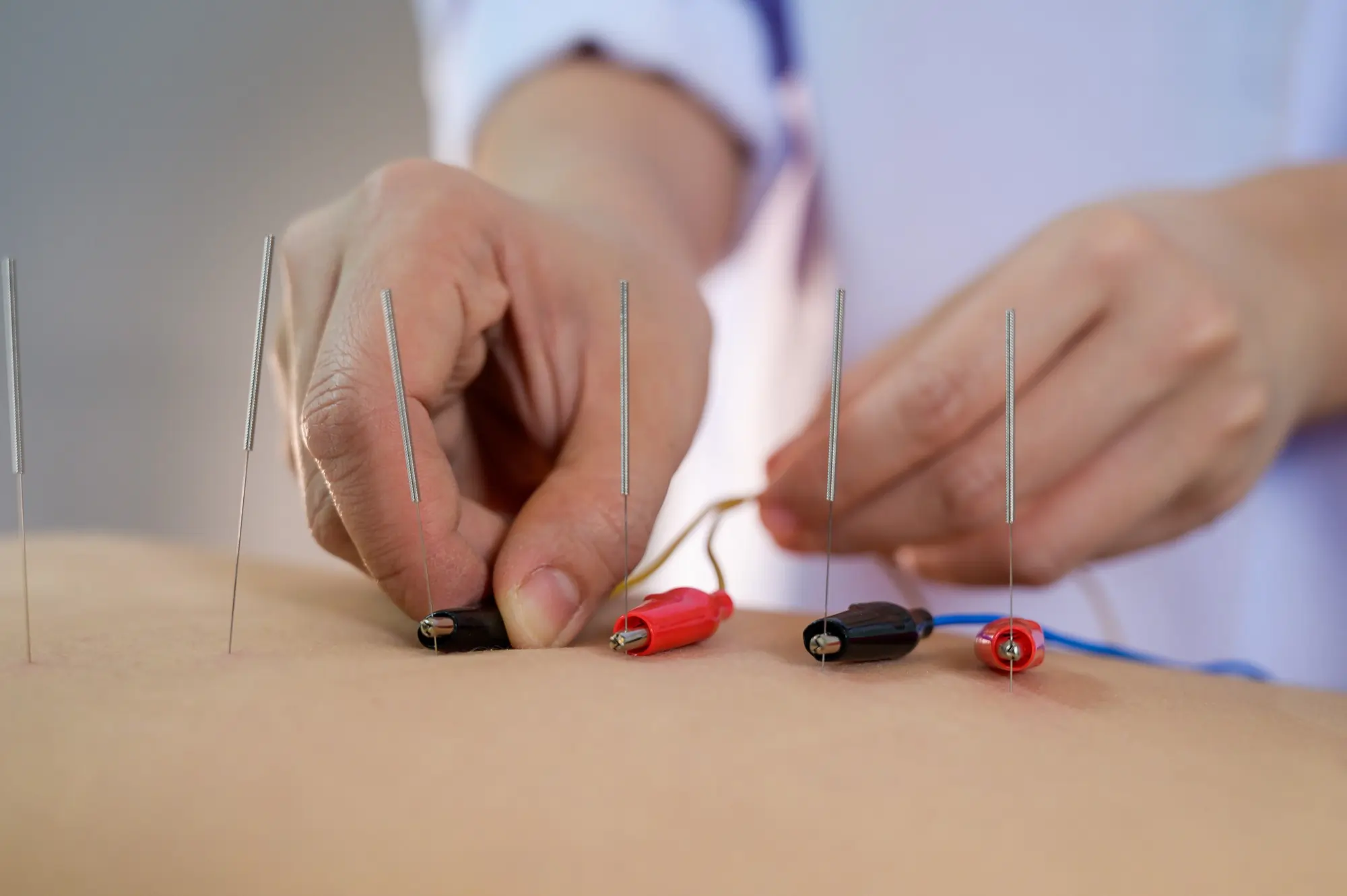 620 Electro-Acupuncture.Traditional Chinese acupuncture and Electro acupuncture on body of patient
